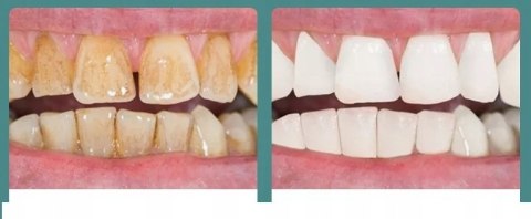 Ultradźwiękowy Skaler Do Zębów Heelly Z 3 Trybami I Led, Biały